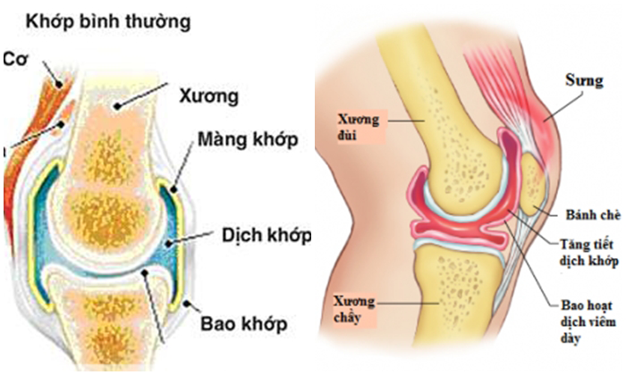 Bệnh viêm bao hoạt dịch là gì?