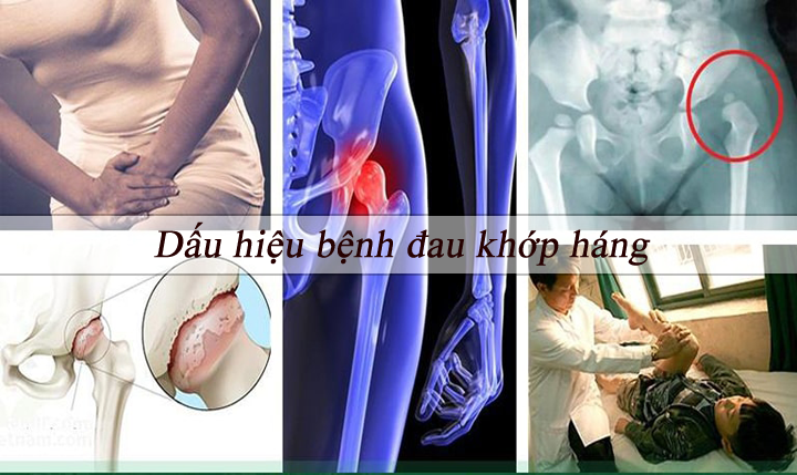 Dấu hiệu bệnh đau khớp háng