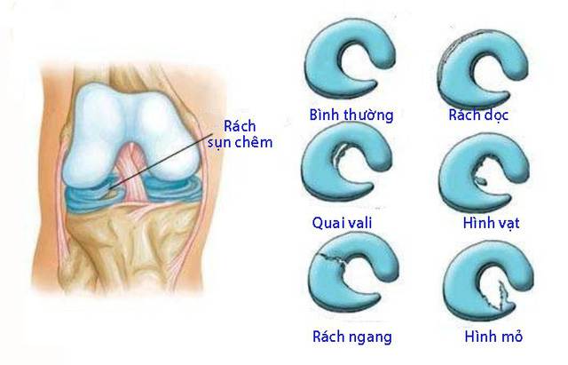 Sụn chêm